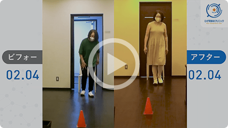 患者様の治療前後の歩行比較動画２